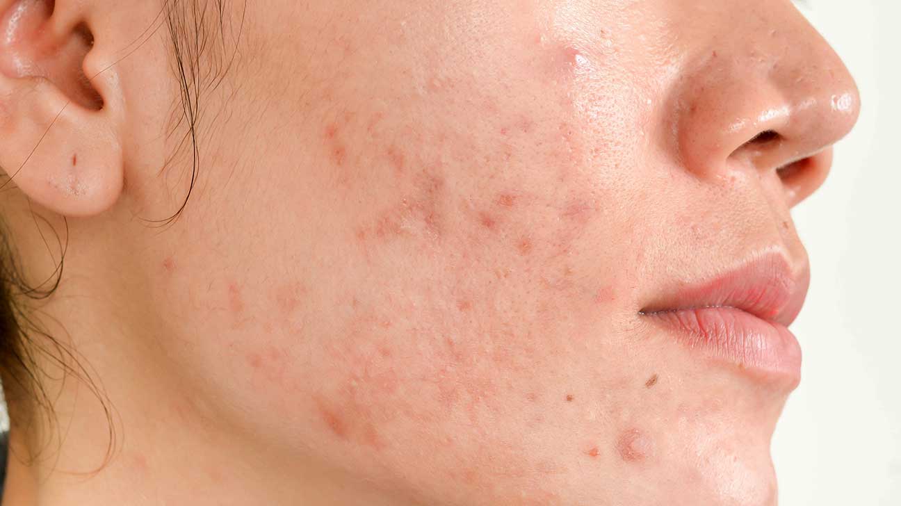 Батга, батганы дараах сорви – MIRUSKINCARE