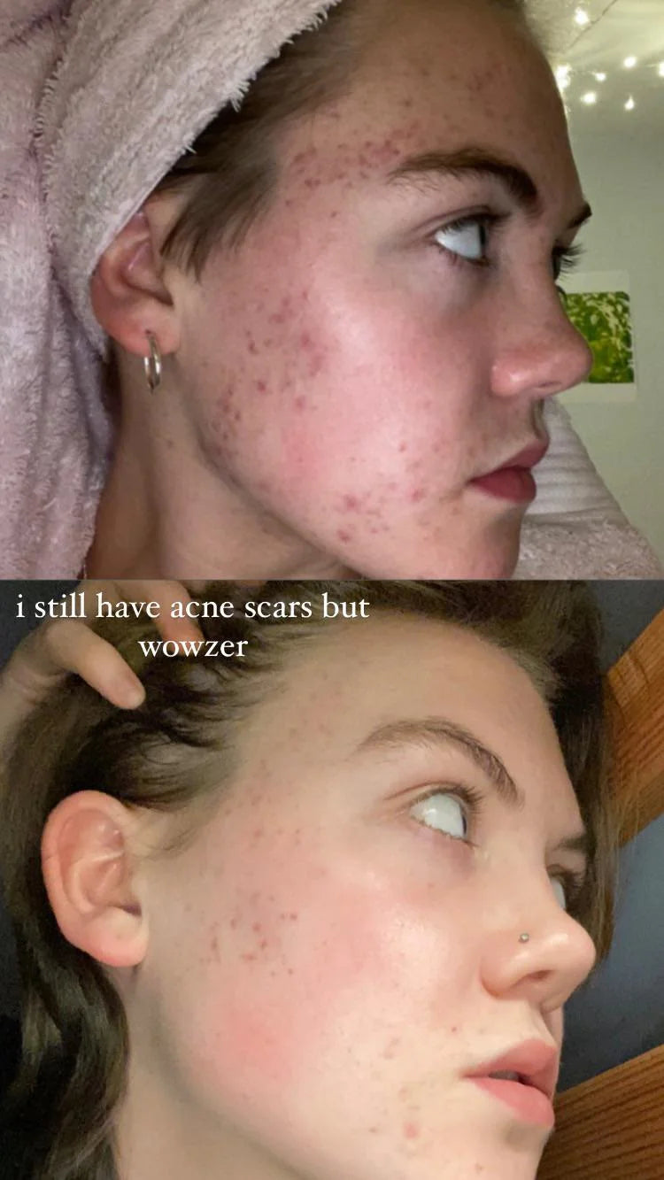 Niacinamide 10% + Zinc 1%