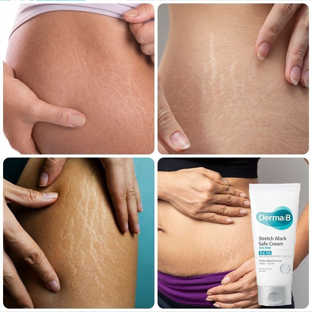 Stretch Mark Safe Cream